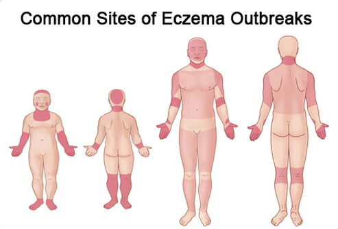Steroids for eczema in infants