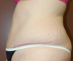 Abdominoplasty