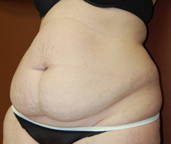 Abdominoplasty