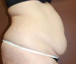 Abdominoplasty