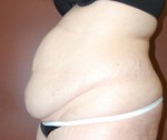 Abdominoplasty