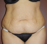 Abdominoplasty