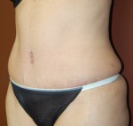 Abdominoplasty