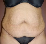 Abdominoplasty