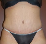 Abdominoplasty