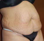 Abdominoplasty