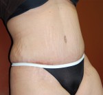 Abdominoplasty