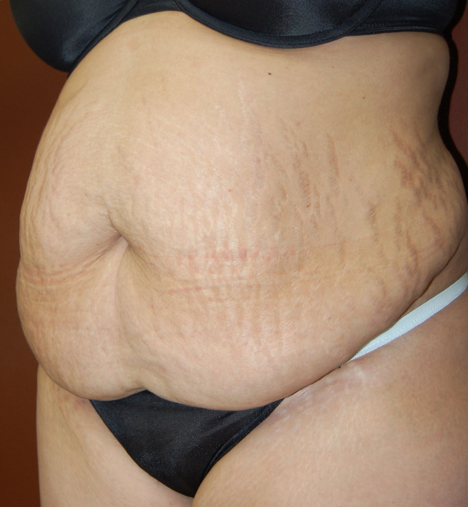 Abdominoplasty