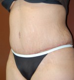 Abdominoplasty