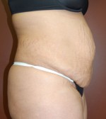 Abdominoplasty