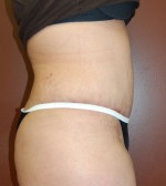 Abdominoplasty