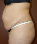 Abdominoplasty