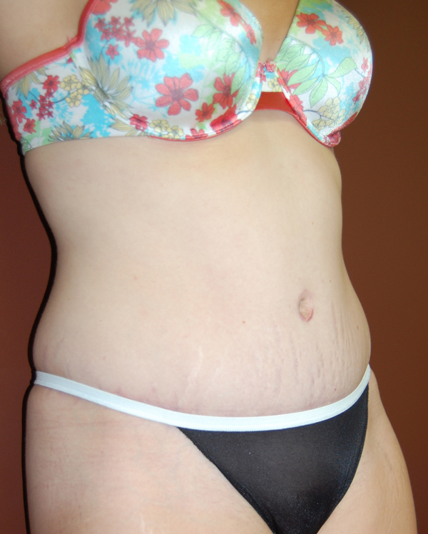 Abdominoplasty