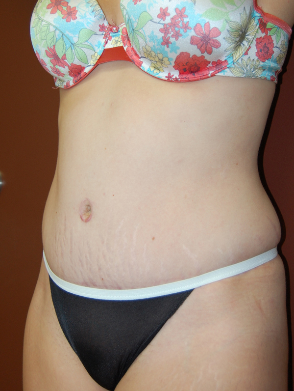 Abdominoplasty