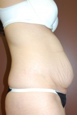 Abdominoplasty