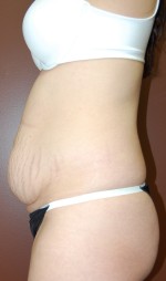 Abdominoplasty