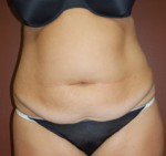 Abdominoplasty