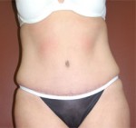 Abdominoplasty