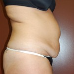 Abdominoplasty