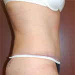 Abdominoplasty