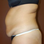 Abdominoplasty