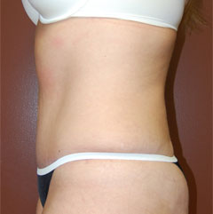 Abdominoplasty