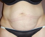 Abdominoplasty