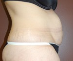 Abdominoplasty