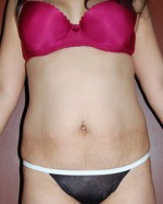 Abdominoplasty