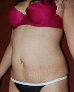 Abdominoplasty