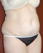 Abdominoplasty