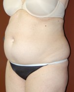 Abdominoplasty