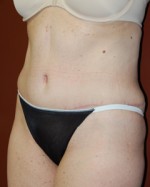 Abdominoplasty