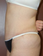 Abdominoplasty