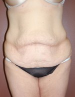 Abdominoplasty