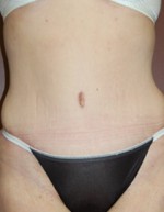 Abdominoplasty