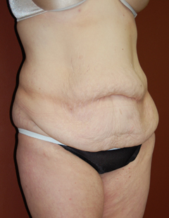 Abdominoplasty