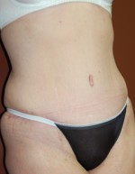 Abdominoplasty