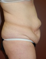 Abdominoplasty