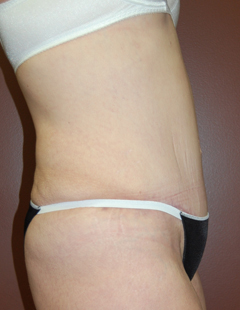 Abdominoplasty