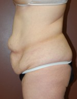 Abdominoplasty