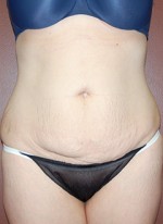 Abdominoplasty