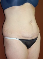 Abdominoplasty