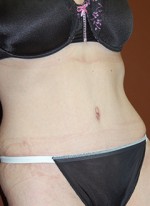 Abdominoplasty