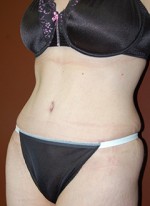 Abdominoplasty