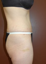 Abdominoplasty