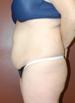 Abdominoplasty
