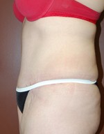 Abdominoplasty