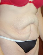 Abdominoplasty