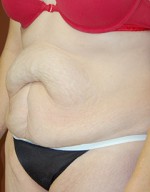 Abdominoplasty